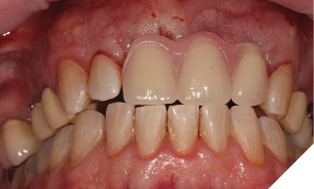 Immediate acrylic partial denture