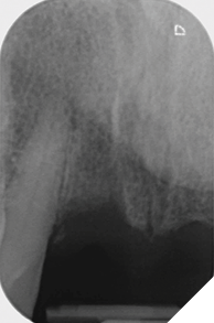 UR1 replacement radiograph.