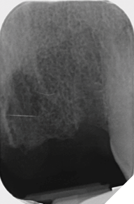 UL2 replacement radiograph.