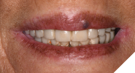 Photos of the patient smiling are critical to analyzing the patient’s smile line.