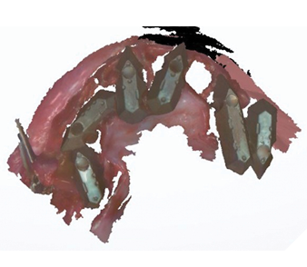 The scan of the Nexus scan gauges only requires capture of the scan gauges for implant position and not the surrounding soft tissue.