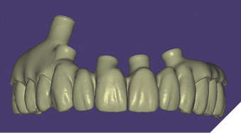 The .STL file of the provisional restoration design is created by a merger of the presurgical virtual wax-up with the actual post-surgical implant position.