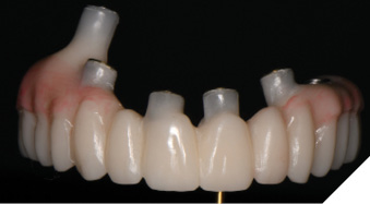 The .STL file of the provisional restoration design is created by a merger of the presurgical virtual wax-up with the actual post-surgical implant position.