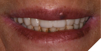 The esthetic result and healing soft tissues are seen 10 days post maxillary implant surgery.