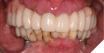 The esthetic result and healing soft tissues are seen 10 days post maxillary implant surgery.
