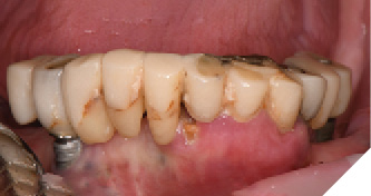 The failing mandibular restoration,
teeth and implants are clearly seen.