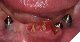 The failing mandibular restoration,
teeth and implants are clearly seen.