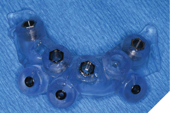A soft tissue borne surgical guide
secured with lateral pins is used for the mandibular implant surgery.