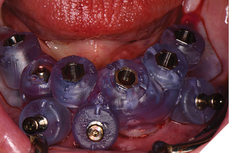 A soft tissue borne surgical guide
secured with lateral pins is used for the mandibular implant surgery.