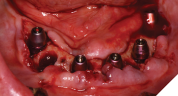 The failing implants and teeth are removed, implants placed, multi-unit abutment inserted and multi-unit healing abutments placed.