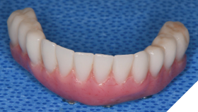 The EasyPro denture conversion system was used for rapid immediate provisionalization.