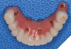 The EasyPro denture conversion system was used for rapid immediate provisionalization.