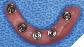 The EasyPro denture conversion system was used for rapid immediate provisionalization.