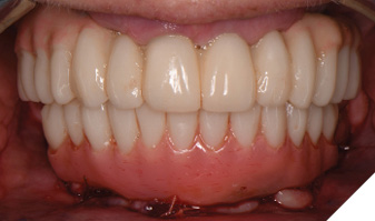 The mandibular provisional restoration is inserted
at the mandibular surgical visit completing the esthetic and occlusal realignment of the patient’s dentition.