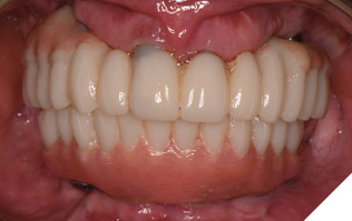 Healthy soft tissue is seen 4 months post maxillary and 3 months post mandibular implant surgery.