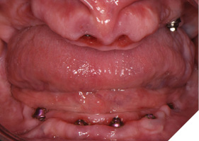 Healthy soft tissue is seen 4 months post maxillary and 3 months post mandibular implant surgery.