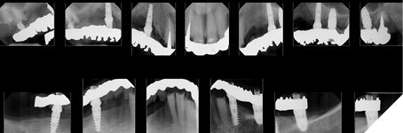 Conventional radiographs are used to evaluate the patient’s remaining dentition and implants and determine their prognosis.