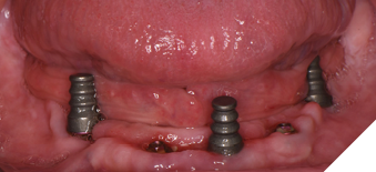 The emergence profile scans to record soft tissue position are taken
with 3 narrow scan abutments.