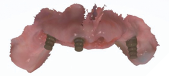 The emergence profile scans to record soft tissue position are taken
with 3 narrow scan abutments.