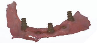 The emergence profile scans to record soft tissue position are taken
with 3 narrow scan abutments.