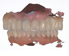 Intraoral scans of the maxillary and mandibular provisional restorations are taken including a scan of centric occlusion.