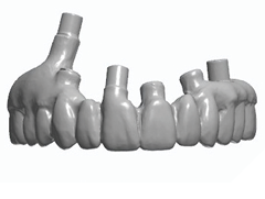 The maxillary and mandibular provisional restorations are removed and scanned 3 dimensionally.