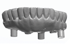 The maxillary and mandibular provisional restorations are removed and scanned 3 dimensionally.