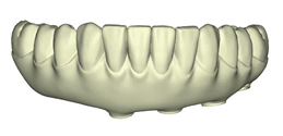The design proposal of the maxillary and mandibular restoration are sent to the clinician for approval.