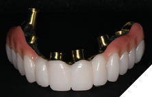 The maxillary restoration is composed of a precision-milled gold anodized titanium bar overlaid with monolithic zirconia.