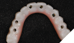 The maxillary restoration is composed of a precision-milled gold anodized titanium bar overlaid with monolithic zirconia.