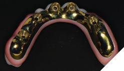 The maxillary restoration is composed of a precision-milled gold anodized titanium bar overlaid with monolithic zirconia.
