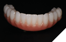 The mandibular restoration demonstrates good implant position for a full arch mandibular restoration.