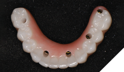 The mandibular restoration demonstrates good implant position for a full arch mandibular restoration.