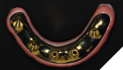 The mandibular restoration demonstrates good implant position for a full arch mandibular restoration.