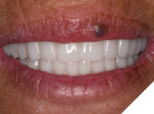 Retention of anterior bone while maintaining an esthetic smile line can be seen. The final result demonstrates that the initial virtual wax-up can be replicated and is an invaluable diagnostic and treatment aid.