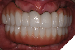 Retention of anterior bone while maintaining an esthetic smile line can be seen. The final result demonstrates that the initial virtual wax-up can be replicated and is an invaluable diagnostic and treatment aid.