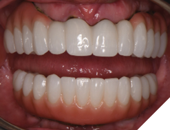 Retention of anterior bone while maintaining an esthetic smile line can be seen. The final result demonstrates that the initial virtual wax-up can be replicated and is an invaluable diagnostic and treatment aid.