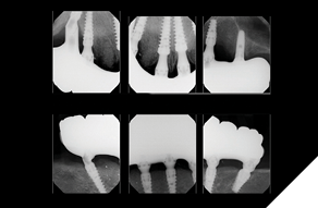 Post final prosthesis insertion radiographs demonstrate good bone maintenance with a completely seated restoration.