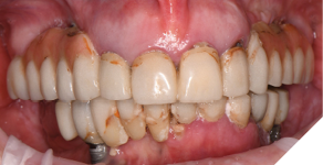 Intraoral photos demonstrate failing maxillary and mandibular restorations and aid in determining a diagnosis, prognosis and treatment plan.