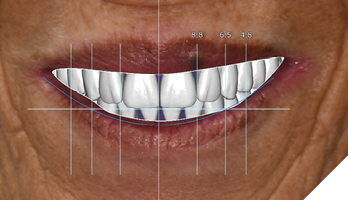The virtual diagnostic wax-up integrated with extraoral photos is a critical element in determining the treatment plan and potential final outcome.