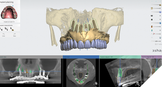 The virtual wax-up is integrated with the CT data to finalize the surgical plan.