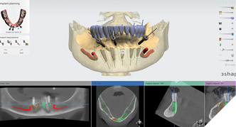 The virtual wax-up is integrated with the CT data to finalize the surgical plan.