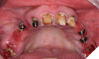 The restorations are removed prior to extractions, exposing the failing teeth and implants.