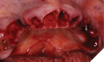 The restorations are removed prior to extractions, exposing the failing teeth and implants.