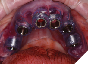 A soft tissue borne surgical guide is paired with a contra-angle based computer guided surgical system for simplified, precise rapid osteotomy creation.