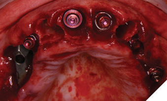 Multi-unit abutments with concave contours simplify abutment insertion at the time of full arch immediate provisionalization.