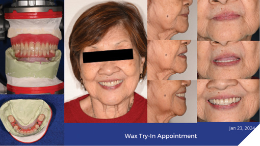 Wax try-in appointment. *Note: Patient tendency to tip
head to right. 