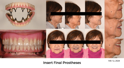 Insertion of new Mx complete denture and Md hybrid IS-FDP after retread.