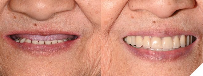 Before and after photos of treatment provided: new maxillary complete denture and retread of existing Md IS-FDP framework.


