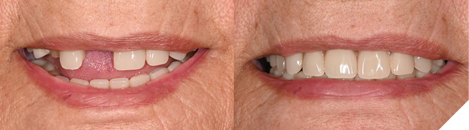 After lab-processed repair